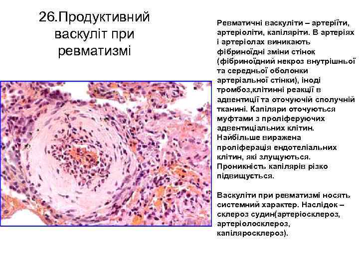 26. Продуктивний васкуліт при ревматизмі Ревматичні васкуліти – артеріїти, артеріоліти, капіляріти. В артеріях і
