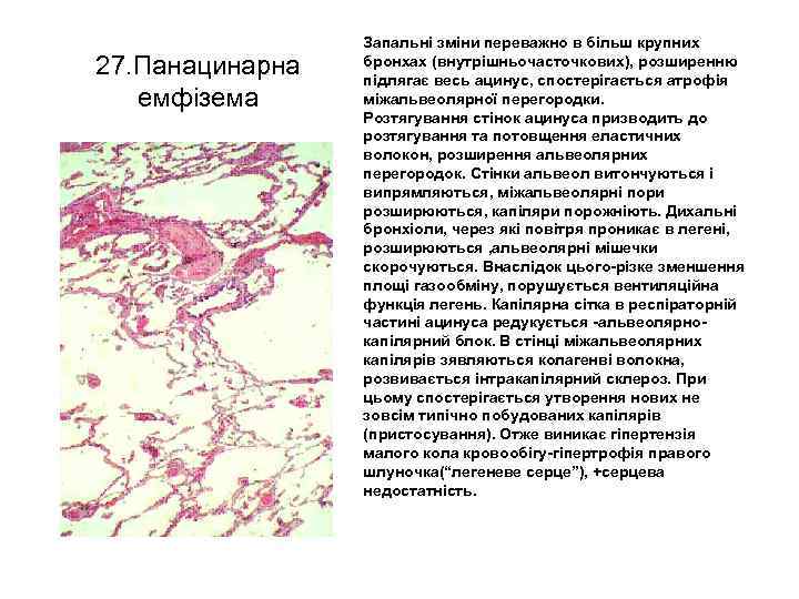 27. Панацинарна емфізема Запальні зміни переважно в більш крупних бронхах (внутрішньочасточкових), розширенню підлягає весь