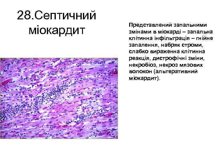 28. Септичний міокардит Представлений запальними змінами в міокарді – запальна клітинна інфільтрація – гнійне