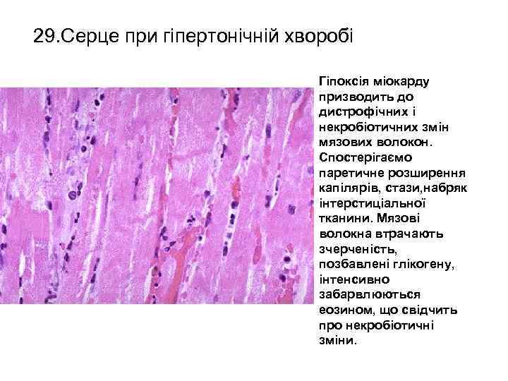 29. Серце при гіпертонічній хворобі Гіпоксія міокарду призводить до дистрофічних і некробіотичних змін мязових