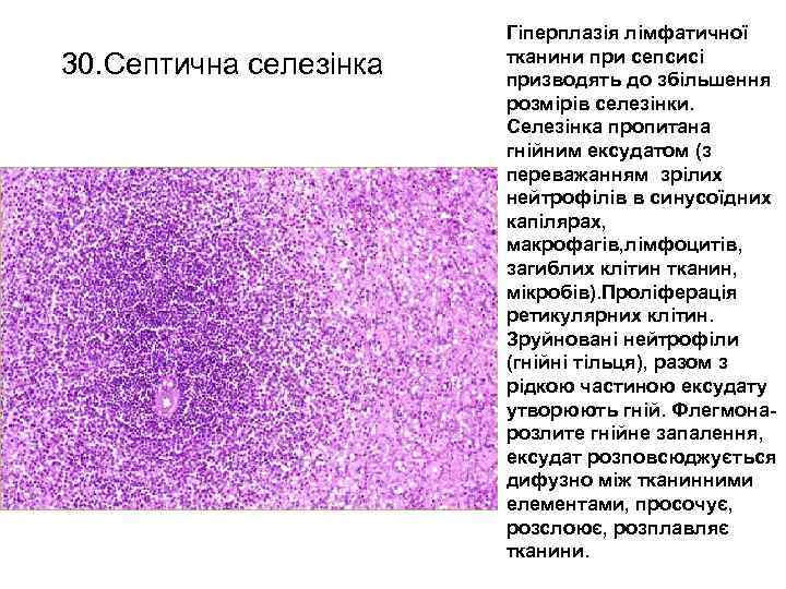 30. Септична селезінка Гіперплазія лімфатичної тканини при сепсисі призводять до збільшення розмірів селезінки. Селезінка