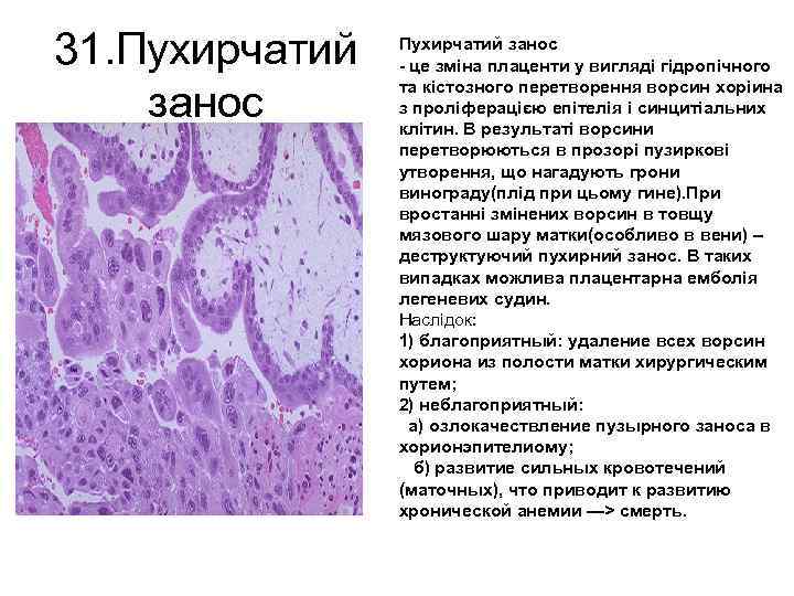 31. Пухирчатий занос - це зміна плаценти у вигляді гідропічного та кістозного перетворення ворсин
