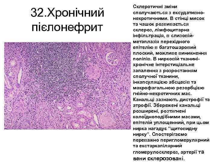 32. Хронічний пієлонефрит Склеротичні зміни сполучаються з ексудативнонекротичними. В стінці мисок та чашок розвивається