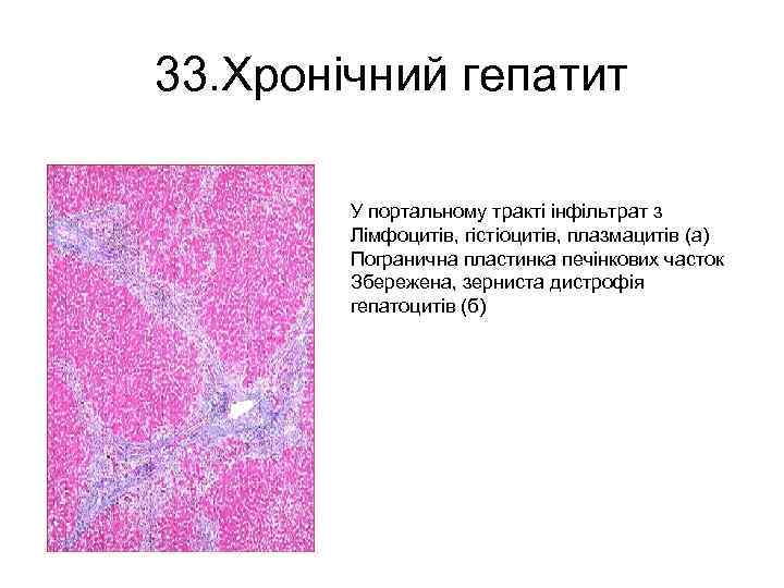 33. Хронічний гепатит У портальному тракті інфільтрат з Лімфоцитів, гістіоцитів, плазмацитів (а) Погранична пластинка