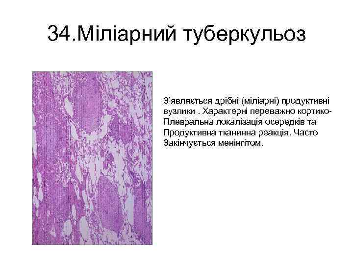 34. Міліарний туберкульоз З’являється дрібні (міліарні) продуктивні вузлики. Характерні переважно кортико. Плевральна локалізація осередків