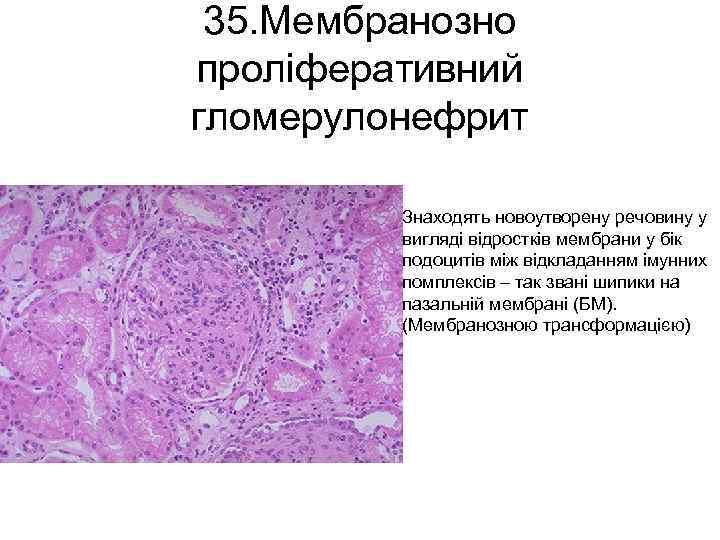 35. Мембранозно проліферативний гломерулонефрит Знаходять новоутворену речовину у вигляді відростків мембрани у бік подоцитів