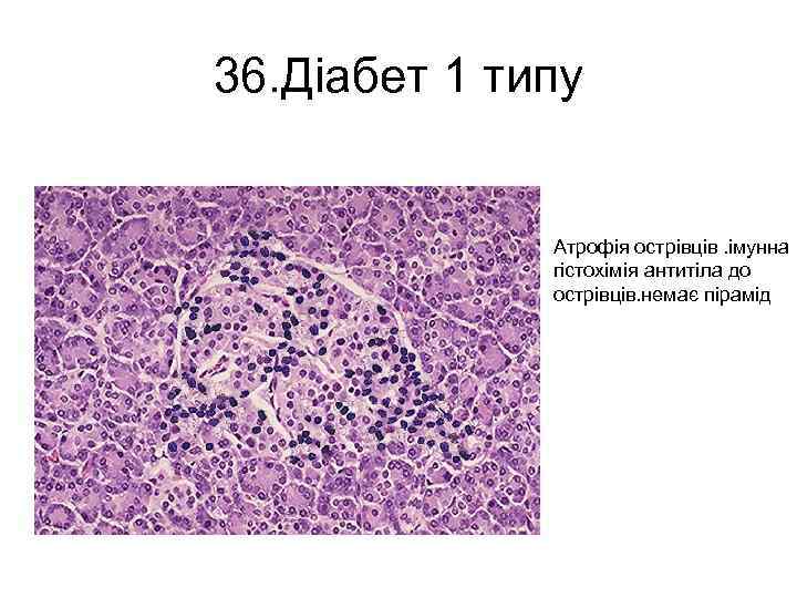 36. Діабет 1 типу Атрофія острівців. імунна гістохімія антитіла до острівців. немає пірамід 