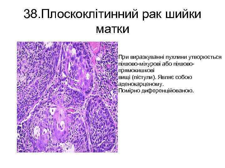 38. Плоскоклітинний рак шийки матки При виразкуванні пухлини утворюється піхвово-міхурові або піхвовопрямокишкові вищі (пістули).