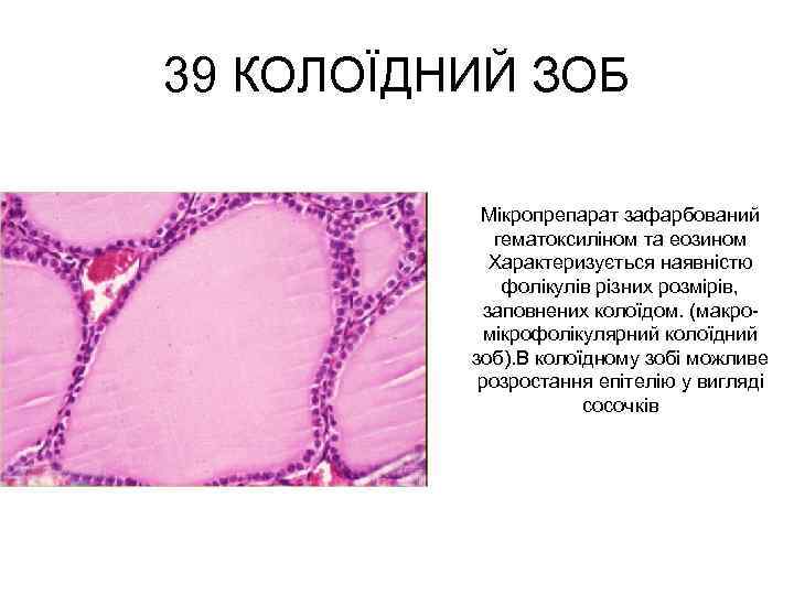 39 КОЛОЇДНИЙ ЗОБ Мікропрепарат зафарбований гематоксиліном та еозином Характеризується наявністю фолікулів різних розмірів, заповнених