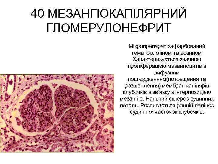 40 МЕЗАНГІОКАПІЛЯРНИЙ ГЛОМЕРУЛОНЕФРИТ Мікропрепарат зафарбований гематоксиліном та еозином Характеризується значною проліферацією мезангіоцитів з дифузним