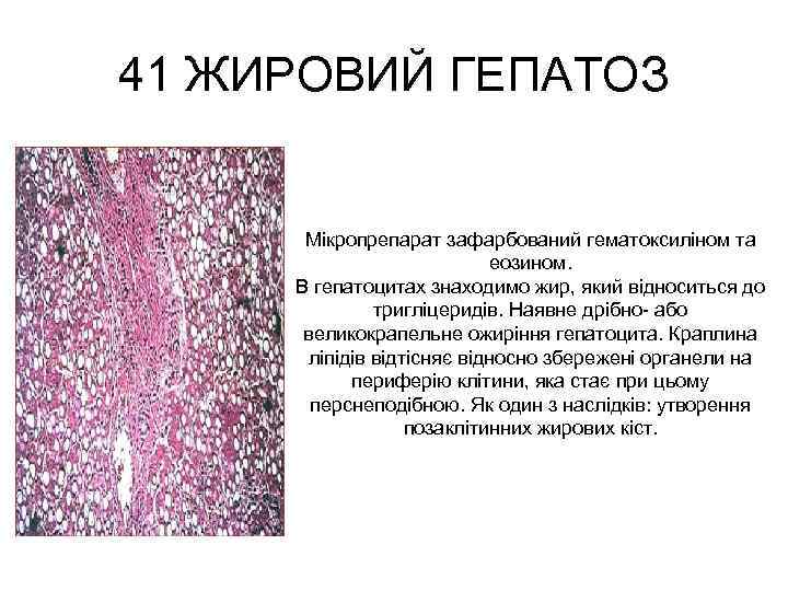 41 ЖИРОВИЙ ГЕПАТОЗ Мікропрепарат зафарбований гематоксиліном та еозином. В гепатоцитах знаходимо жир, який відноситься