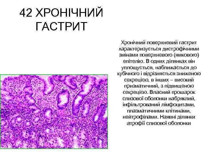 42 ХРОНІЧНИЙ ГАСТРИТ Хронічний поверхневий гастрит характеризується дистрофічними змінами поверхневого (ямкового) епітелію. В одних