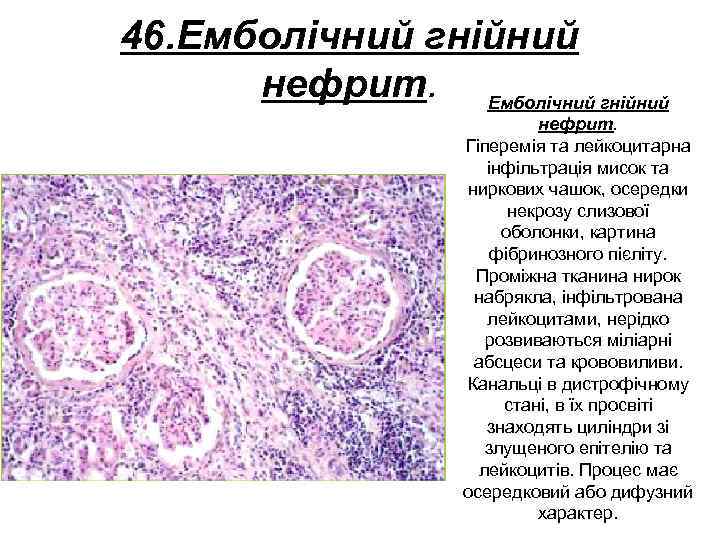 46. Емболічний гнійний нефрит. Гіперемія та лейкоцитарна інфільтрація мисок та ниркових чашок, осередки некрозу
