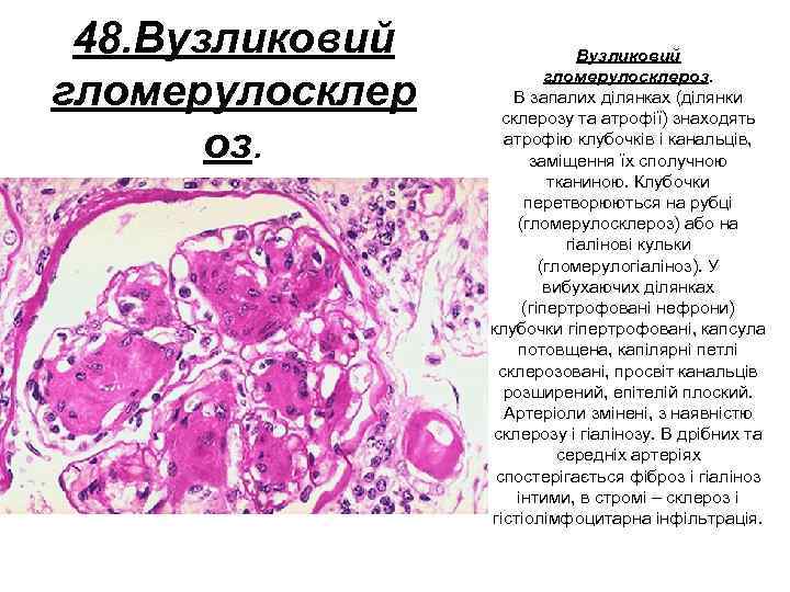 48. Вузликовий гломерулосклер оз. Вузликовий гломерулосклероз. В запалих ділянках (ділянки склерозу та атрофії) знаходять