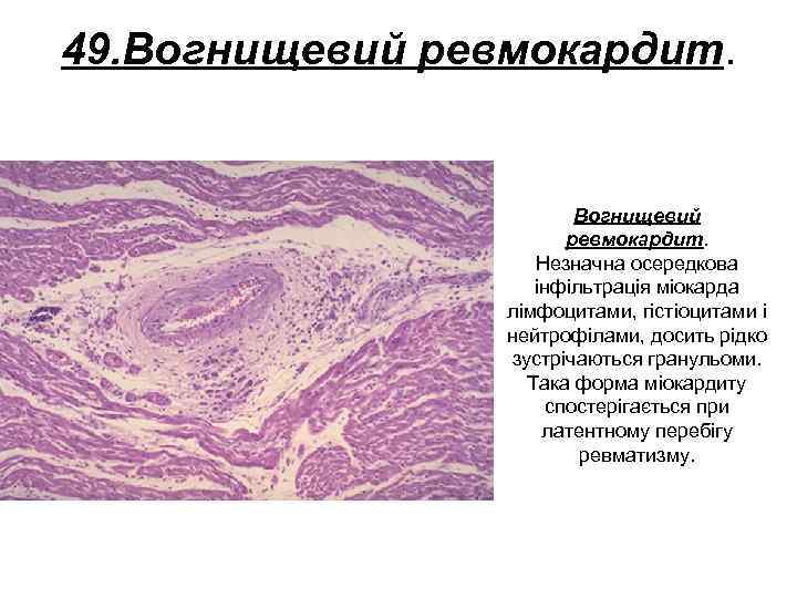 49. Вогнищевий ревмокардит. Незначна осередкова інфільтрація міокарда лімфоцитами, гістіоцитами і нейтрофілами, досить рідко зустрічаються