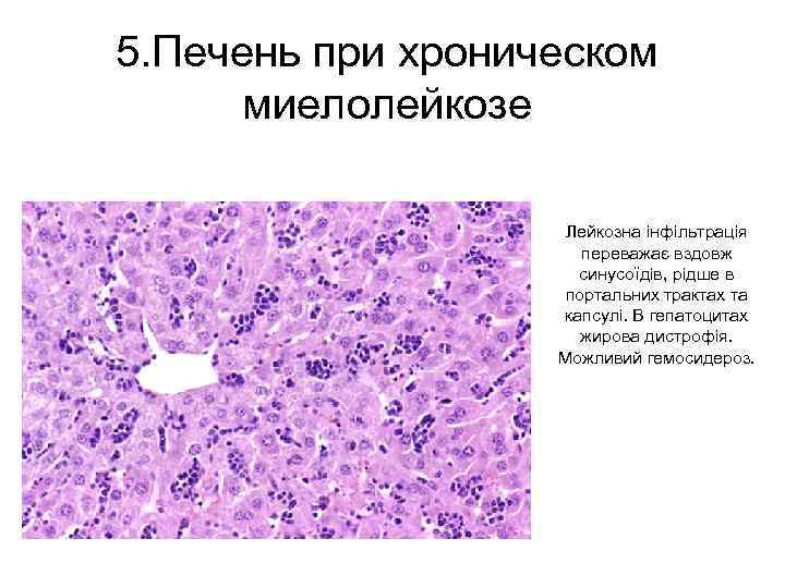 5. Печень при хроническом миелолейкозе Лейкозна інфільтрація переважає вздовж синусоїдів, рідше в портальних трактах