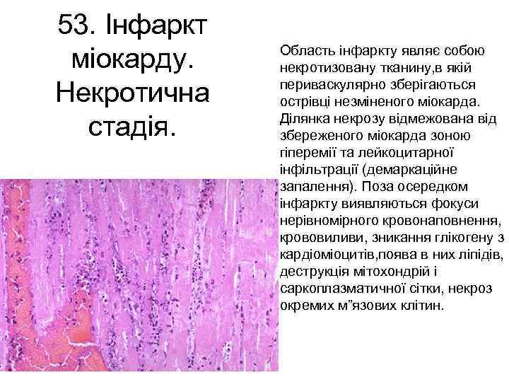 53. Інфаркт міокарду. Некротична стадія. Область інфаркту являє собою некротизовану тканину, в якій периваскулярно