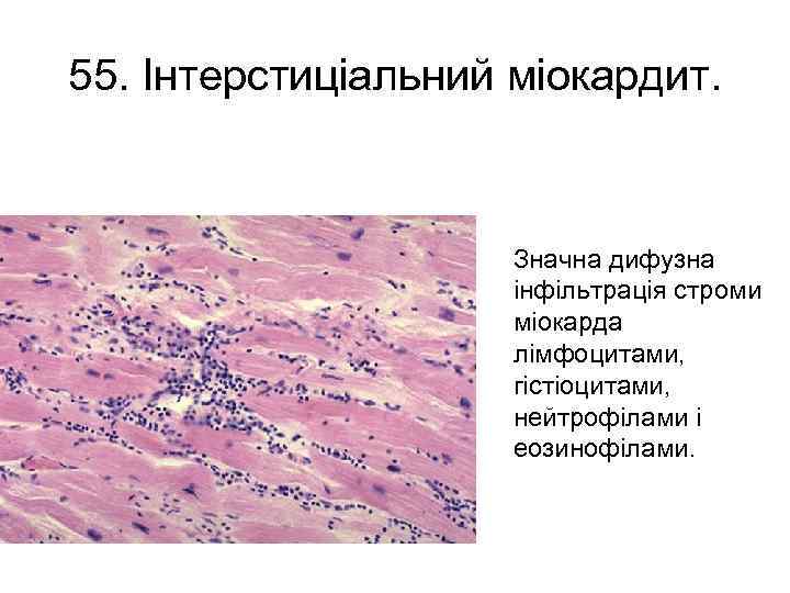 55. Інтерстиціальний міокардит. Значна дифузна інфільтрація строми міокарда лімфоцитами, гістіоцитами, нейтрофілами і еозинофілами. 