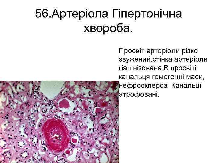 56. Артеріола Гіпертонічна хвороба. Просвіт артеріоли різко звужений, стінка артеріоли гіалінізована. В просвіті канальця