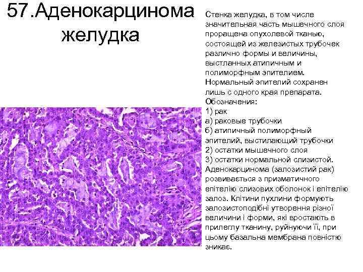 57. Аденокарцинома желудка Стенка желудка, в том числе значительная часть мышечного слоя проращена опухолевой