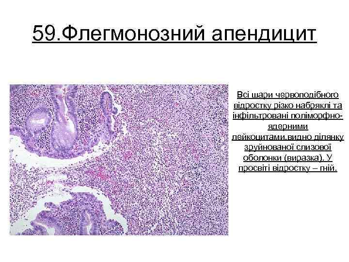 59. Флегмонозний апендицит Всі шари червоподібного відростку різко набряклі та інфільтровані поліморфноядерними лейкоцитами, видно