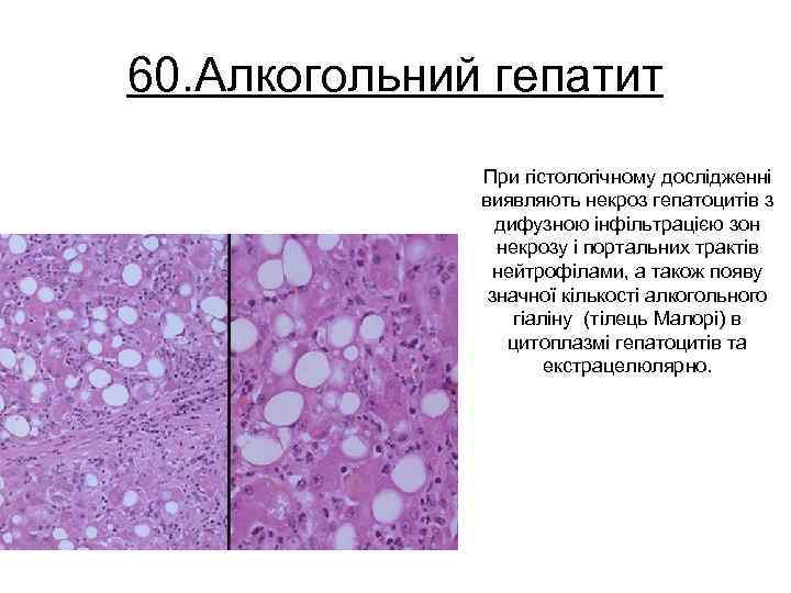 60. Алкогольний гепатит При гістологічному дослідженні виявляють некроз гепатоцитів з дифузною інфільтрацією зон некрозу