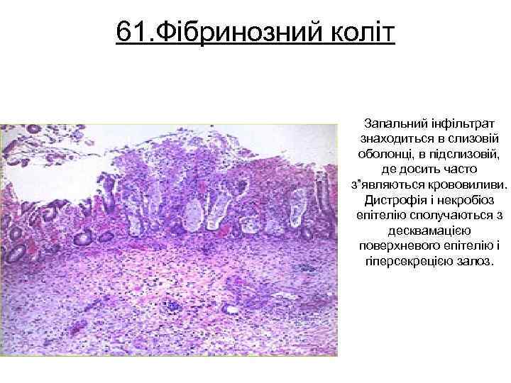 61. Фібринозний коліт Запальний інфільтрат знаходиться в слизовій оболонці, в підслизовій, де досить часто