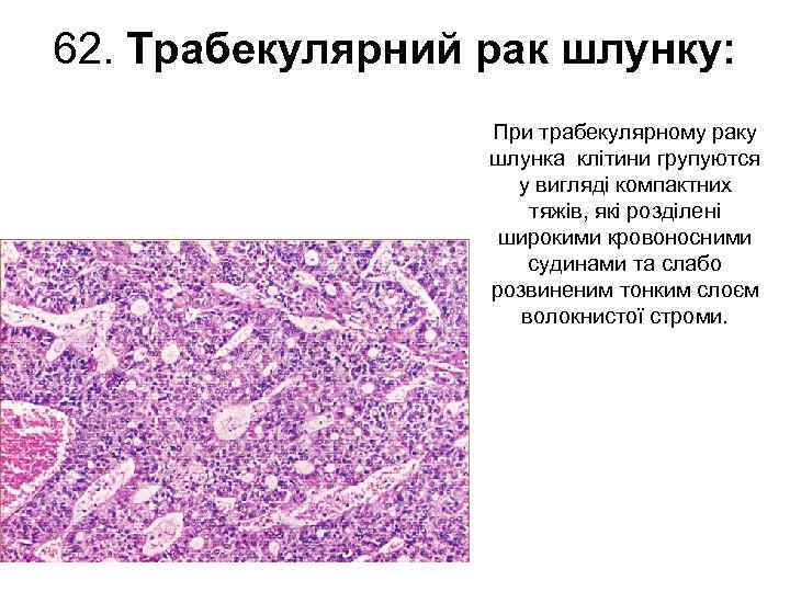 62. Трабекулярний рак шлунку: При трабекулярному раку шлунка клітини групуются у вигляді компактних тяжів,