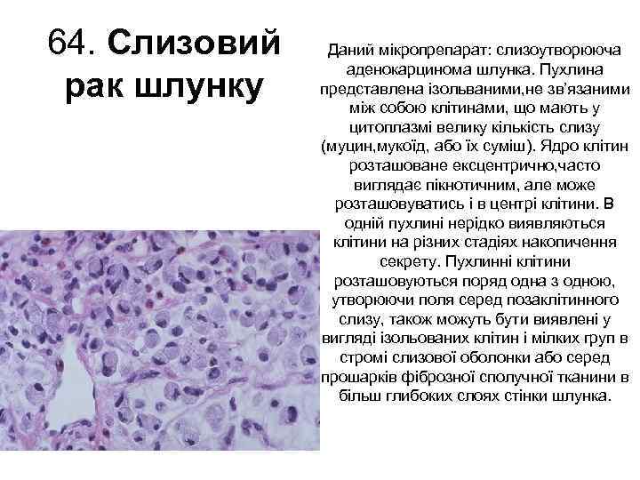 64. Слизовий рак шлунку Даний мікропрепарат: слизоутворююча аденокарцинома шлунка. Пухлина представлена ізольваними, не зв’язаними