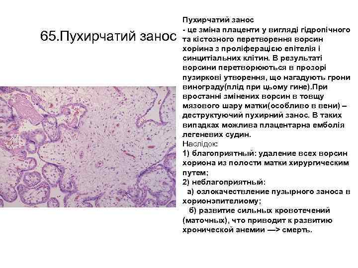 65. Пухирчатий занос - це зміна плаценти у вигляді гідропічного та кістозного перетворення ворсин