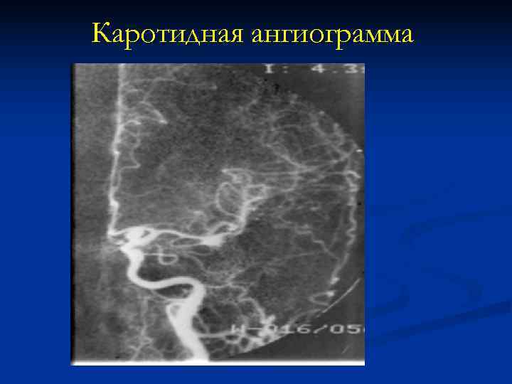 Каротидная ангиограмма Каротидная ангиограмма