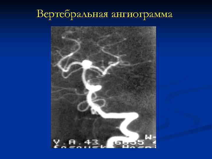 Вертебральная ангиограмма Вертебральная ангиограмма