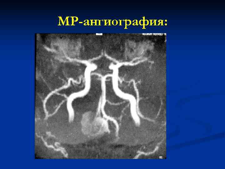 МР-ангиография: МР-ангиография: