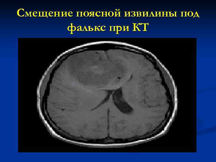 Смещение поясной извилины под  фалькс при КТ 