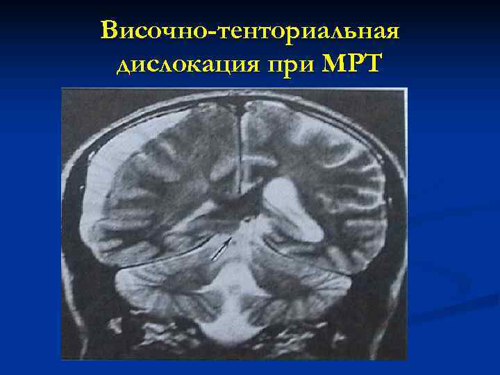 Височно-тенториальная дислокация при МРТ 