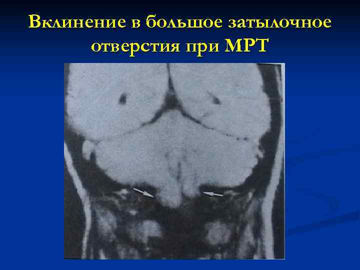 Вклинение в большое затылочное  отверстия при МРТ 