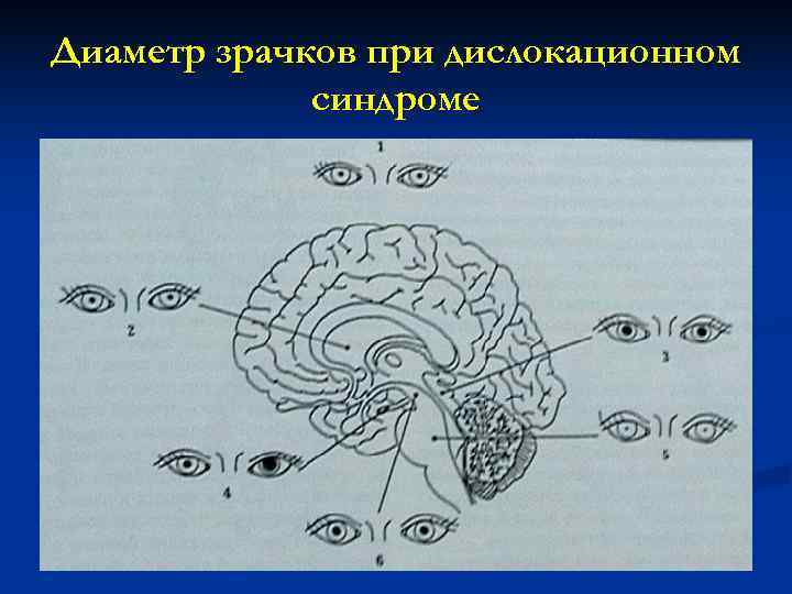 Диаметр зрачков при дислокационном   синдроме 