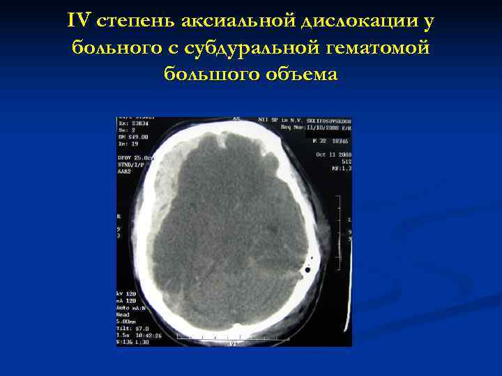 IV степень аксиальной дислокации у больного с субдуральной гематомой   большого объема 
