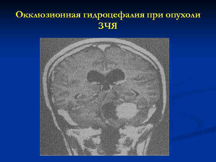 Окклюзионная гидроцефалия при опухоли   ЗЧЯ 
