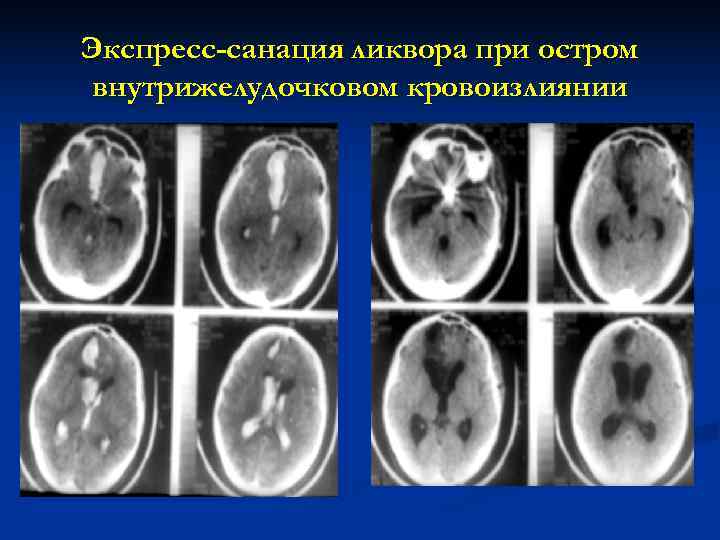 Экспресс-санация ликвора при остром внутрижелудочковом кровоизлиянии 