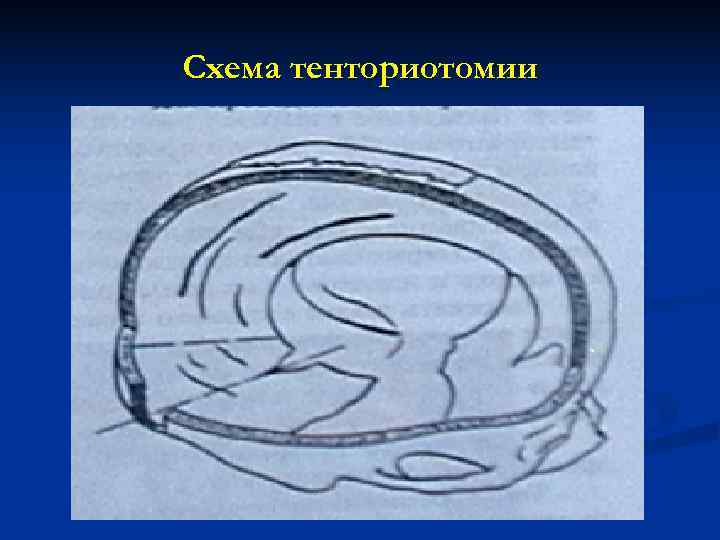 Схема тенториотомии 