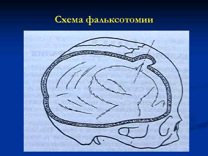 Схема фальксотомии 