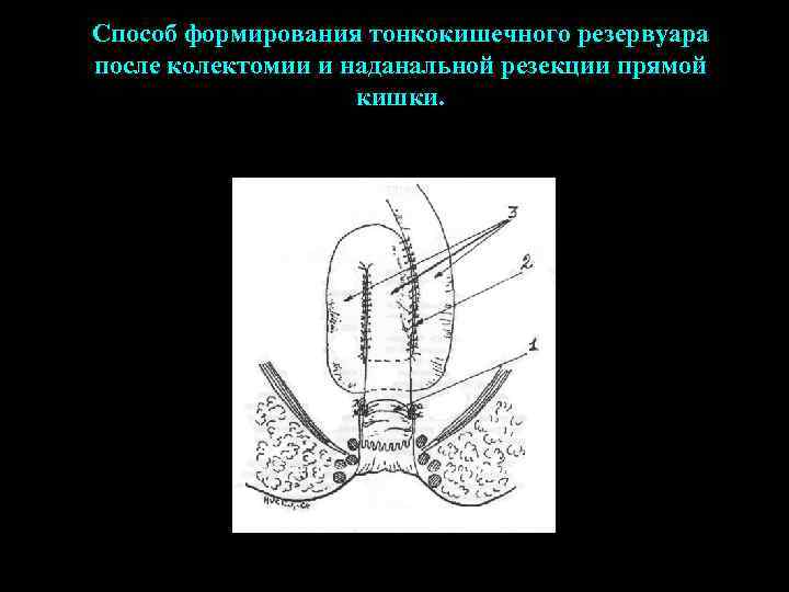 Способ формирования тонкокишечного резервуара после колектомии и наданальной резекции прямой    