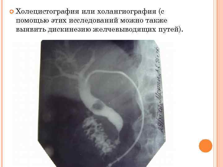   Холецистография или холангиография (с помощью этих исследований можно также выявить дискинезию желчевыводящих