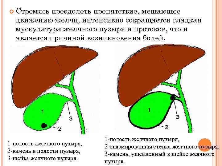   Стремясь преодолеть препятствие, мешающее движению желчи, интенсивно сокращается гладкая мускулатура желчного пузыря