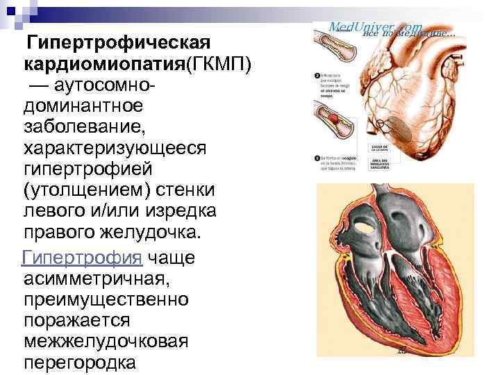   Гипертрофическая кардиомиопатия(ГКМП) — аутосомно-  доминантное заболевание, характеризующееся гипертрофией (утолщением) стенки левого