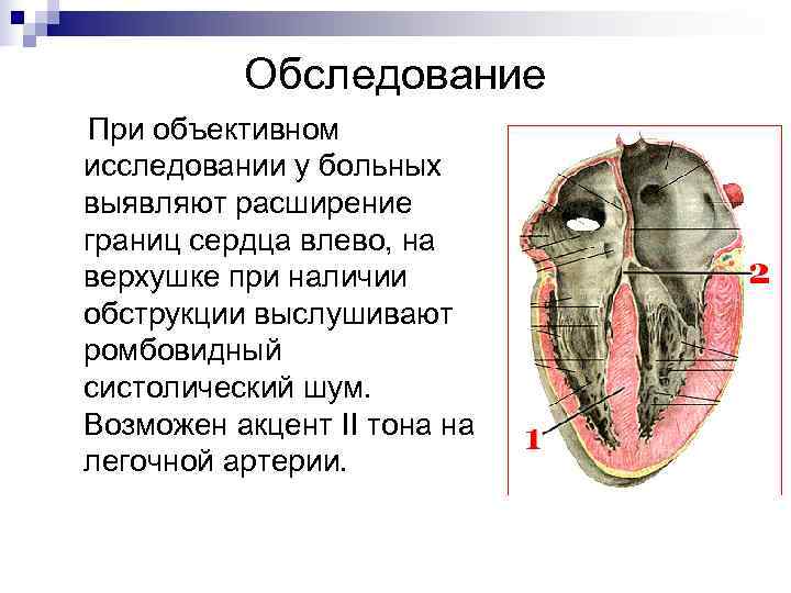    Обследование При объективном исследовании у больных выявляют расширение границ сердца влево,