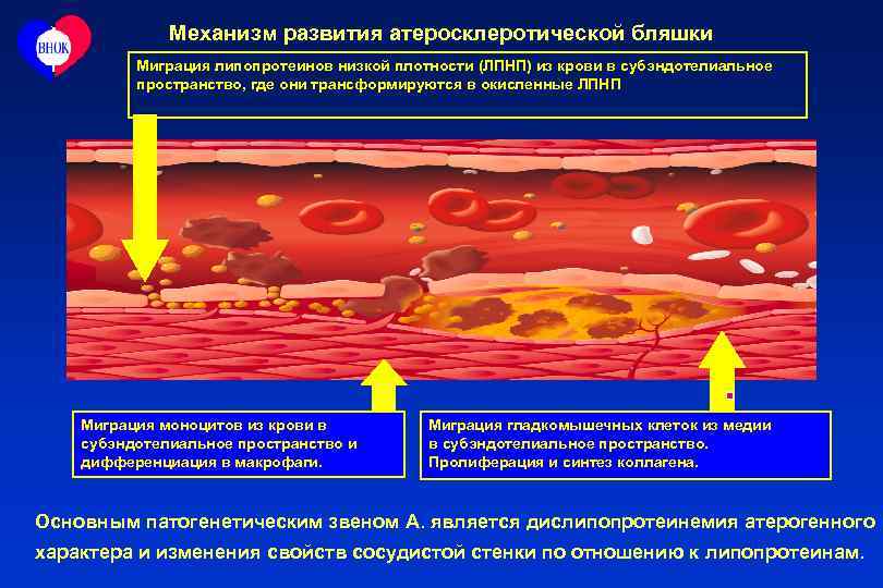 Механизм развития атеросклеротической бляшки Миграция липопротеинов низкой плотности (ЛПНП) из крови в субэндотелиальное пространство,