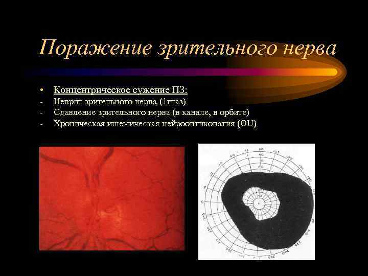 Поражение зрительного нерва • Концентрическое сужение ПЗ: -  Неврит зрительного нерва (1 глаз)