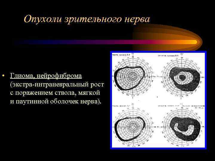  Опухоли зрительного нерва • Глиома, нейрофиброма  (экстра-интраневральный рост  с поражением ствола,
